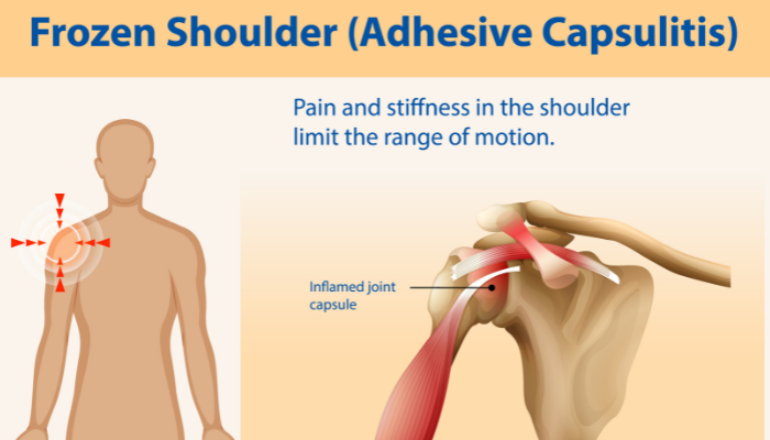 Frozen shoulder anatomy